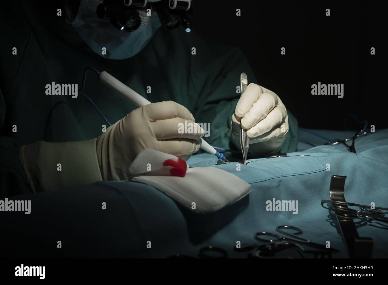 La chirurgien féminine effectue une opération de micro-chirurgie sur un bras. Banque D'Images