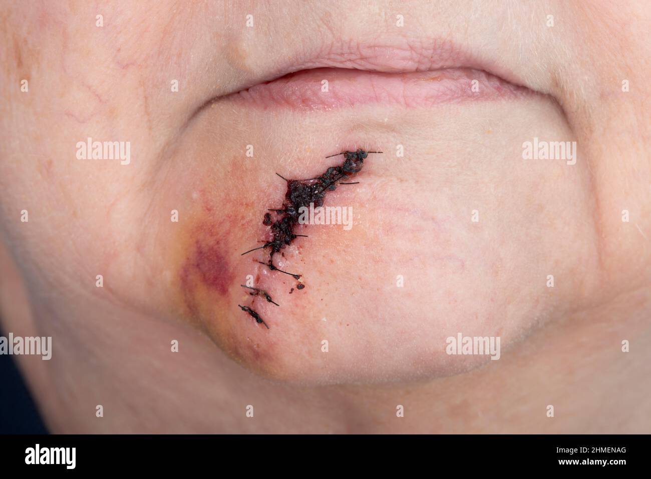 Plan horizontal d'une suture post-chirurgicale entre sa lèvre inférieure et son menton après une chirurgie du cancer de la peau. Banque D'Images