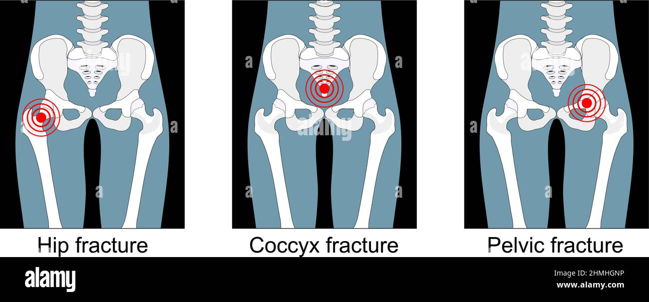 fracture de la hanche, rupture du sacrum ou du pelvis, douleur dans le coccyx. vue de face. Définir les icônes. Noir et blanc. Illustration vectorielle plate. Illustration de Vecteur