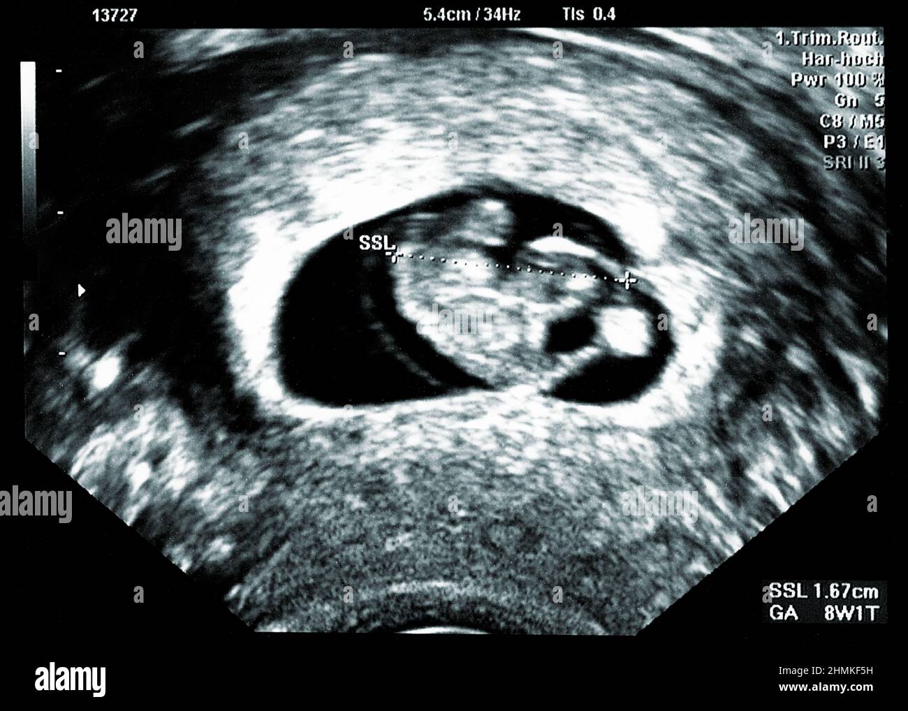 Échographie petit bébé à 8 semaines. 8 semaines d'échographie de grossesse montrent le développement du bébé ou du fœtus et la santé de la grossesse à un hôpital Banque D'Images