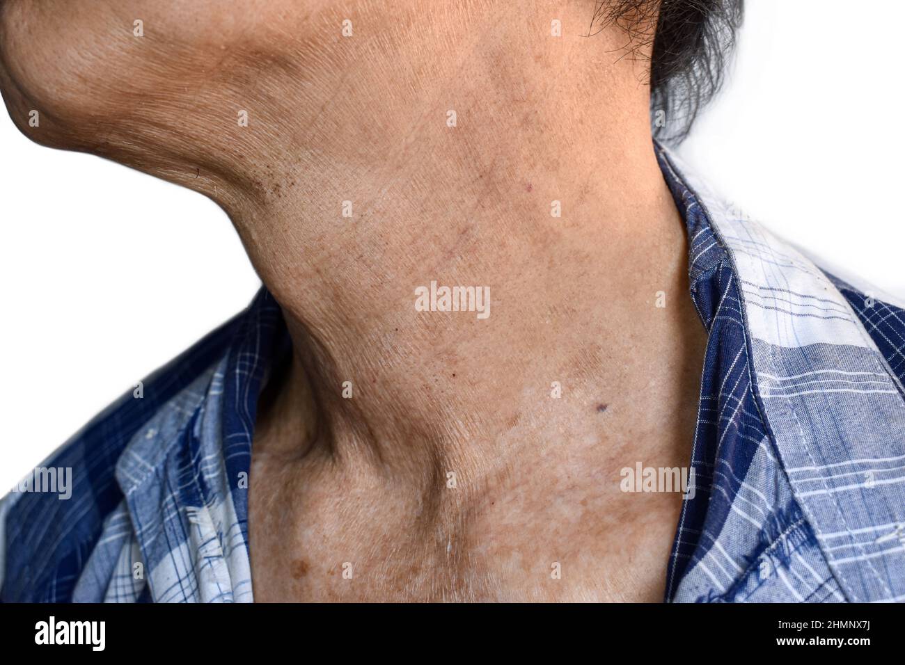 Plis de la peau vieillissante ou plis de la peau ou rides au cou de l'asiatique du Sud-est, vieil homme chinois. Banque D'Images