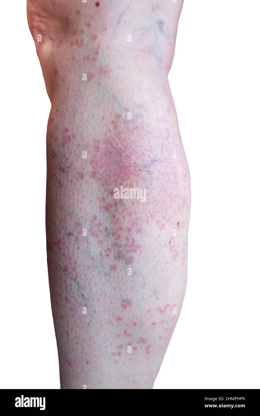 Détail d'un Granuloma annulare généralisé, une maladie rare de la peau, sur une jambe d'une patiente Banque D'Images