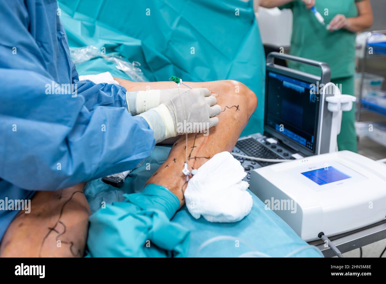 Processus de chirurgie de la veine variqueuse dans l'hôpital, salle d'opération, scellement de la veine, chirurgie vasculaire veineuse concept Banque D'Images