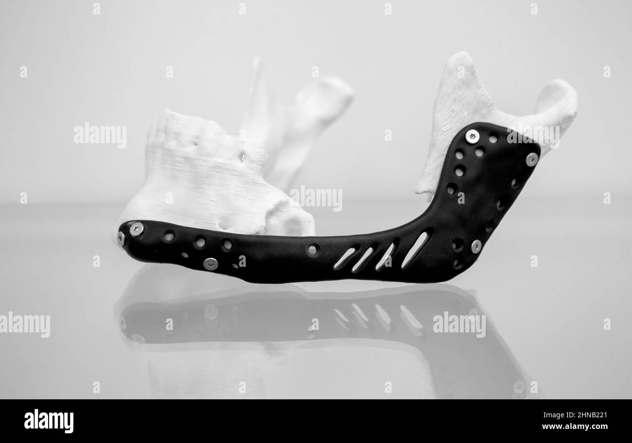 Implantation de l'endoprothèse de la mâchoire inférieure. Imprimante 3D à mâchoire inférieure Banque D'Images