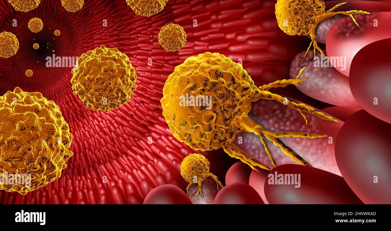 L'anatomie du cancer de l'intestin intérieur concept comme la croissance tumorale maligne à l'intérieur d'un organe de digestion avec des villosités et des cryptes intestinales. Banque D'Images