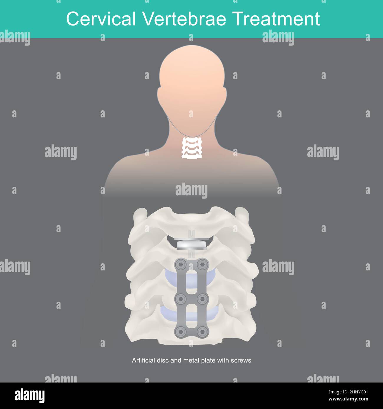 Traitement des vertèbres cervicales. Anatomie de l'os du cou et remplacement du disque artificiel. Illustration de Vecteur