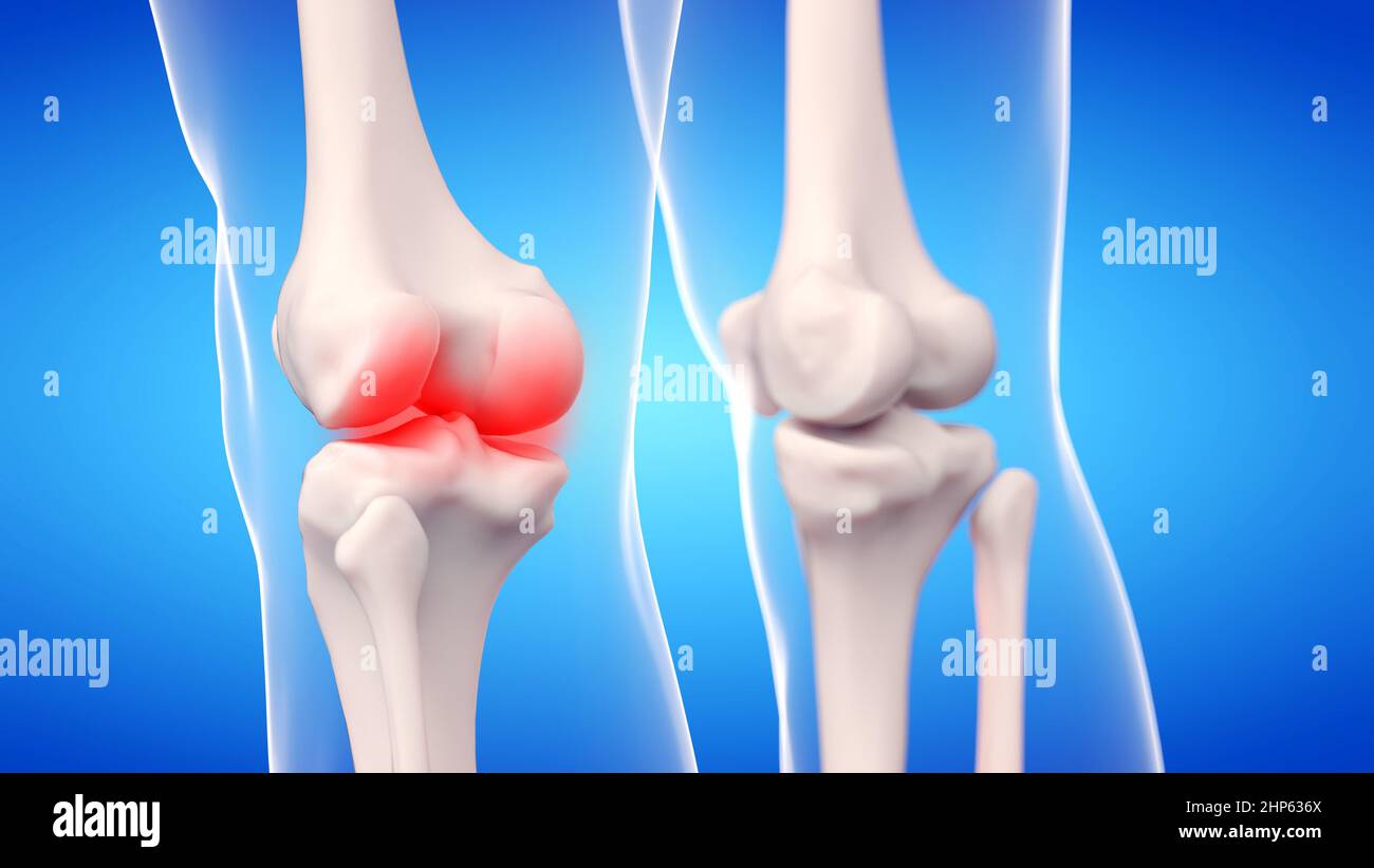 Articulations douloureuses du genou, illustration. Banque D'Images