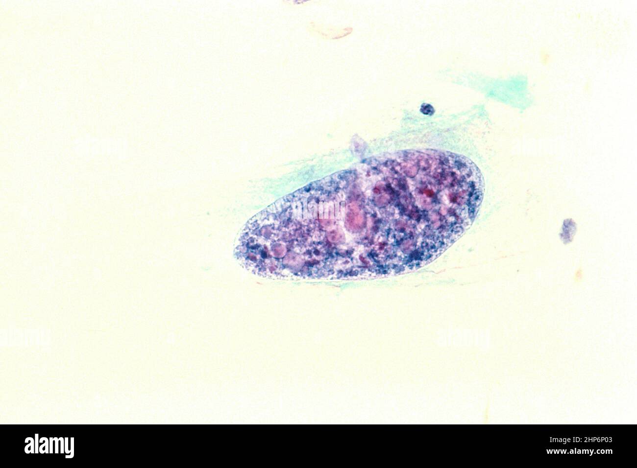 Histiocytome fibreux humain malin aspiré d'une masse de jambe. Tache PAP, grossie à 400 x ca. Mars 1988 Banque D'Images