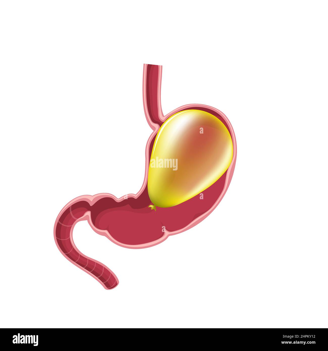 Ballon gastrique estomac. Illustration vectorielle plate Illustration de Vecteur