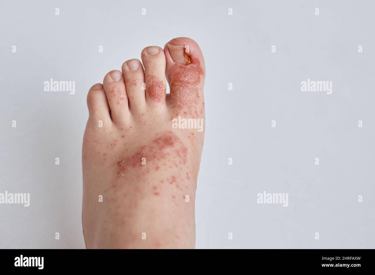 ongle du pied incarné et éruption allergique sur la peau du pied. Problèmes dermatologiques, eczéma humide et dysplasie de la plaque à ongles Banque D'Images