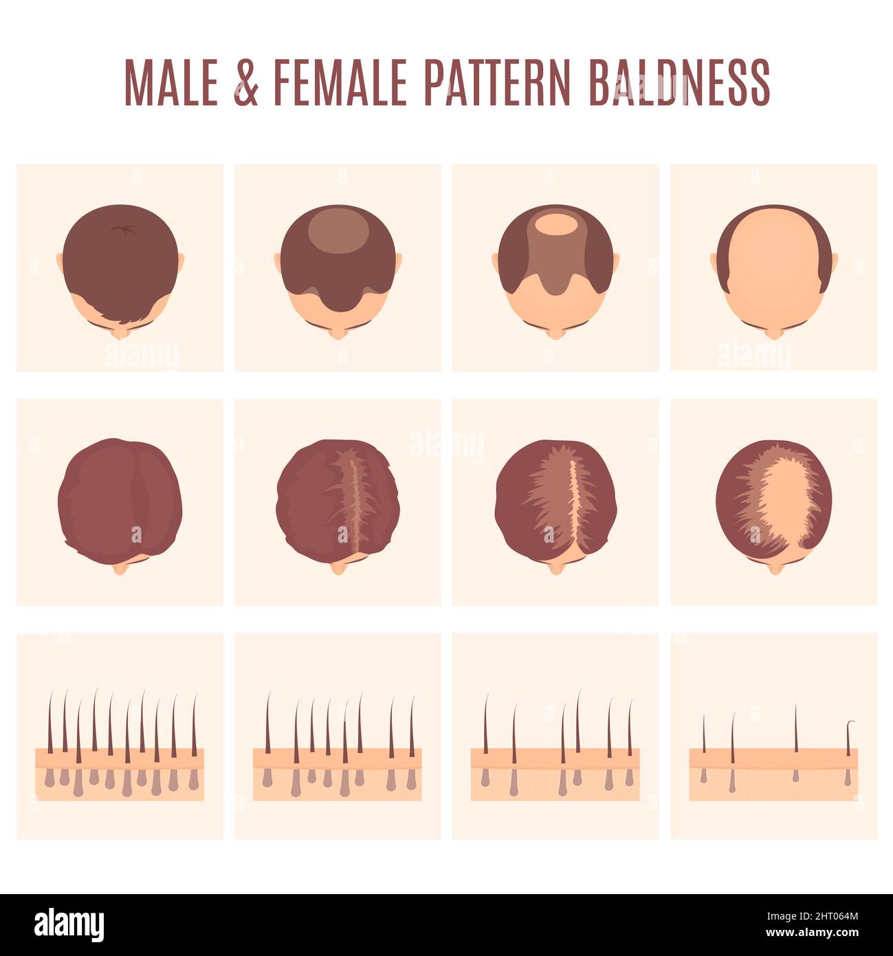 Modèles de perte de cheveux masculins et féminins, illustration ...