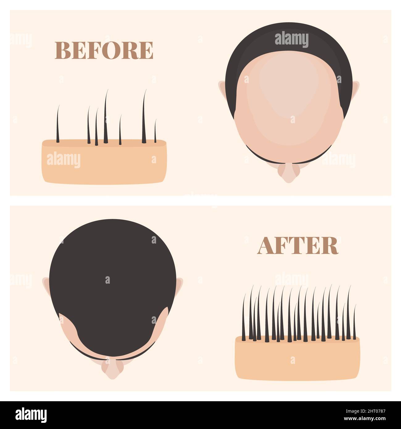 Traitement de l'alopécie, illustration Banque D'Images