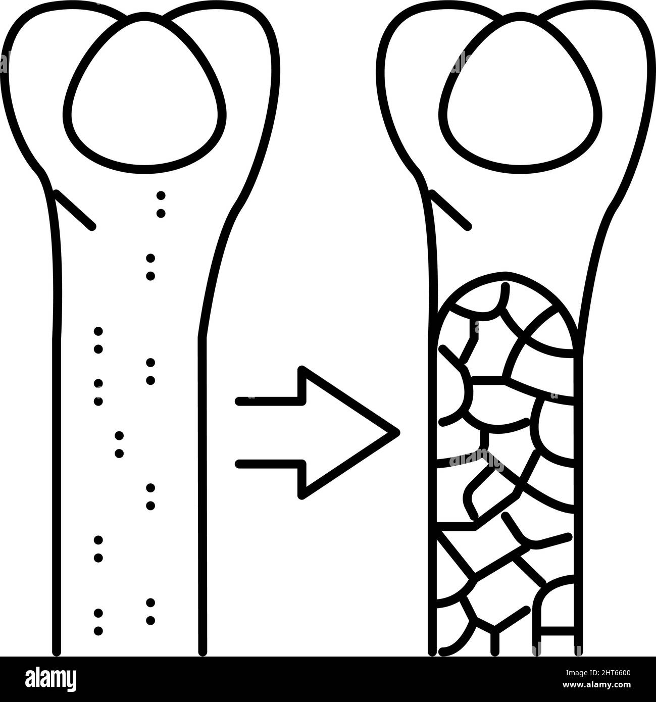 illustration du vecteur de l'icône de la ligne de la maladie osseuse de l'ostéoporose Illustration de Vecteur