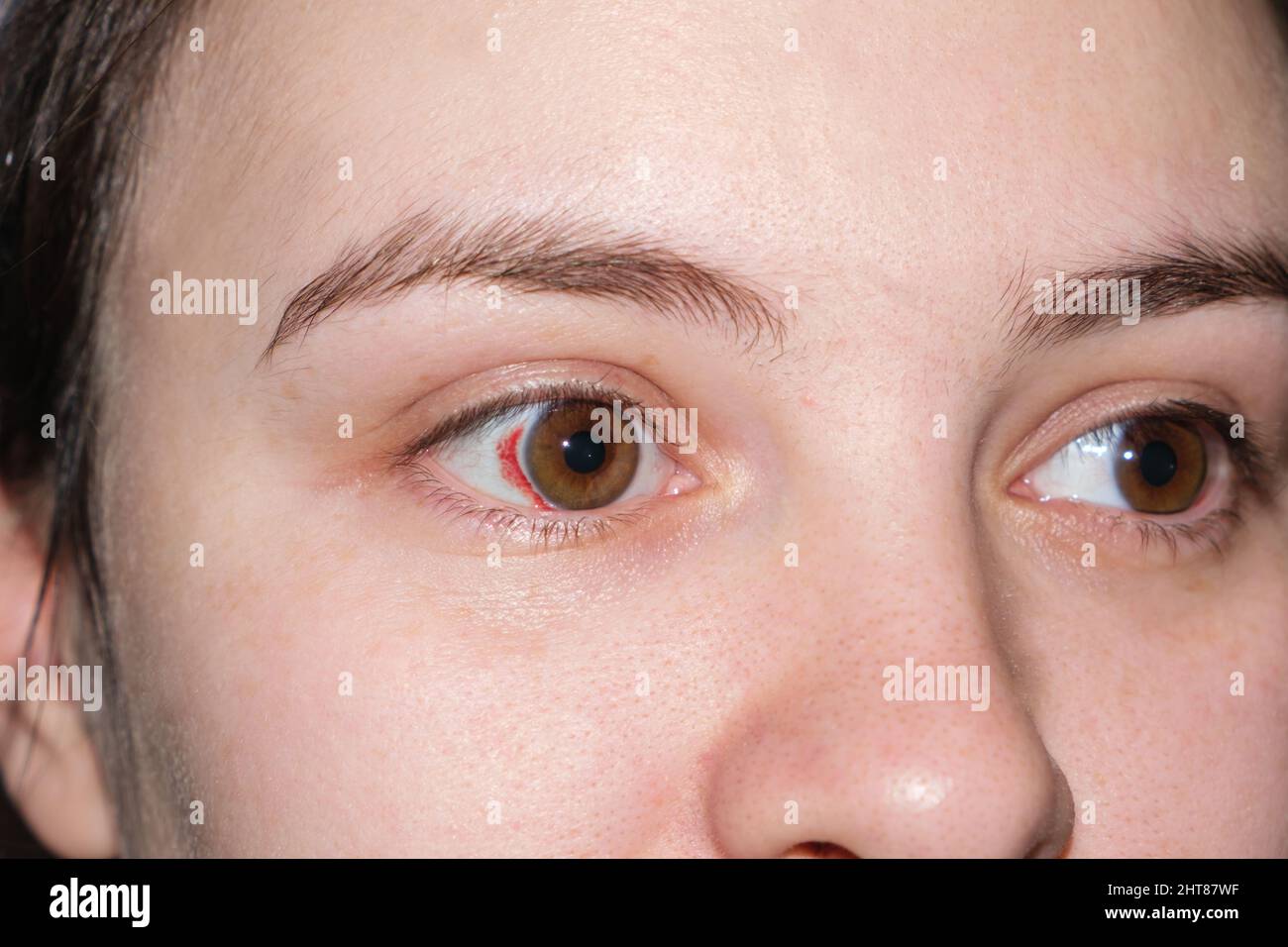 œil Injecte De Sang Yeux Banque D Image Et Photos Alamy