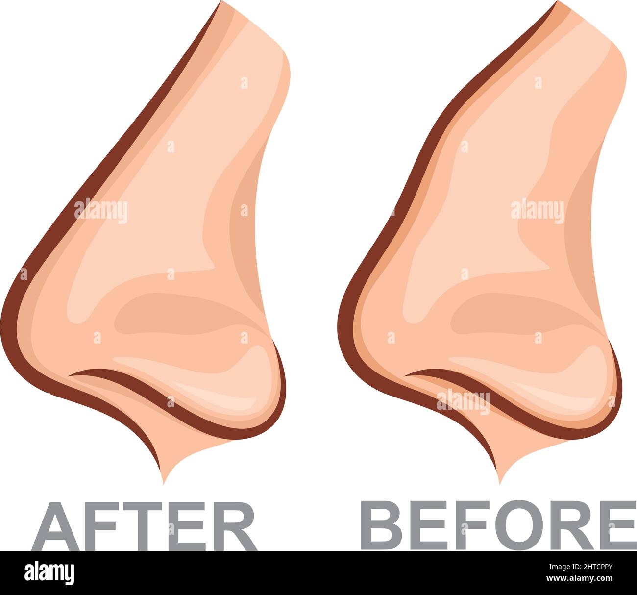 Illustration du vecteur de rhinoplastie avant et après le nez Illustration de Vecteur