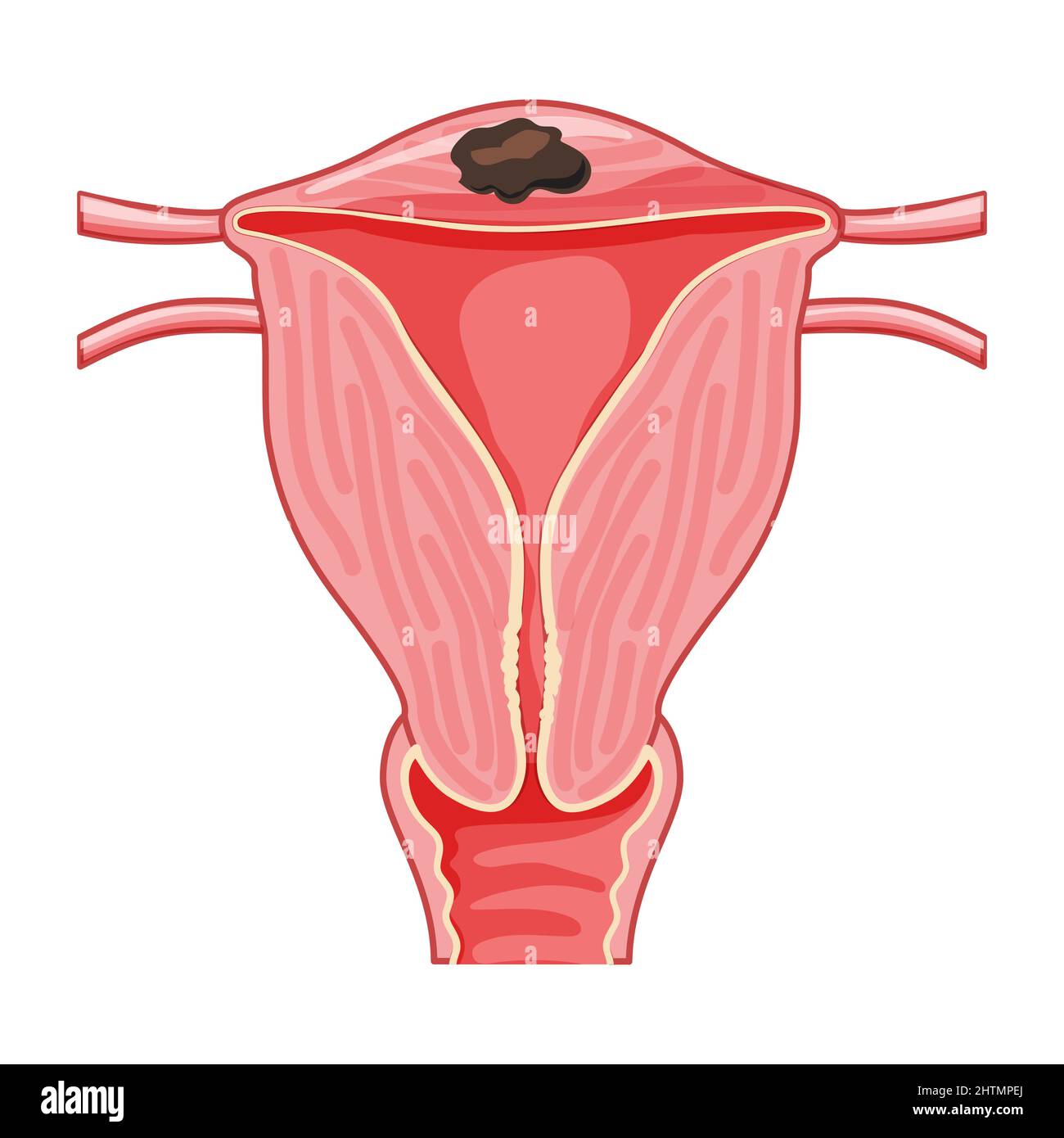 Adenomyose focale anatomie humaine système de reproduction des femmes, organes. Schéma de