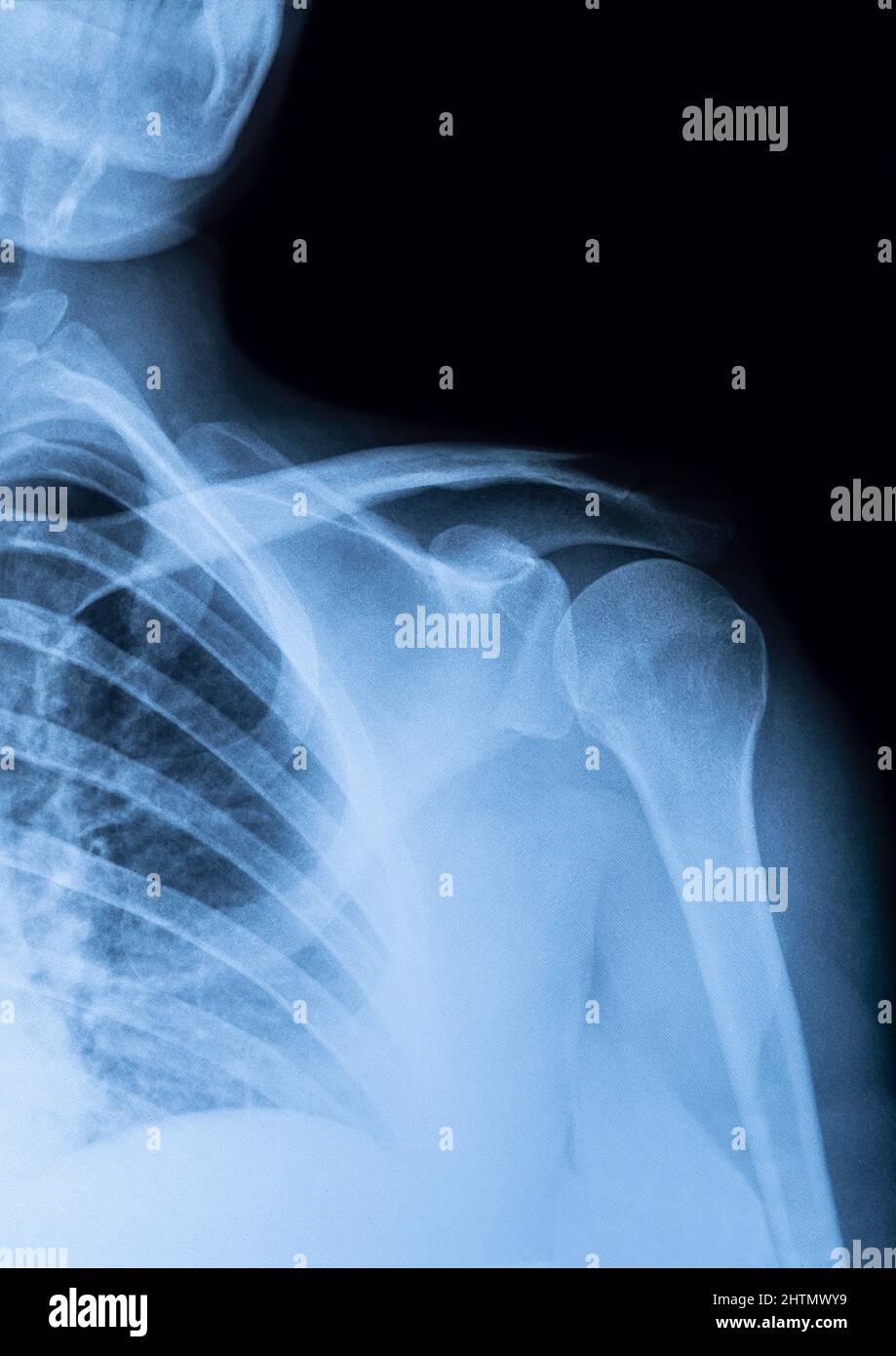 les rayons x sont des images de l'articulation de l'épaule pour voir les blessures des tendons et des os pour un diagnostic médical. Banque D'Images