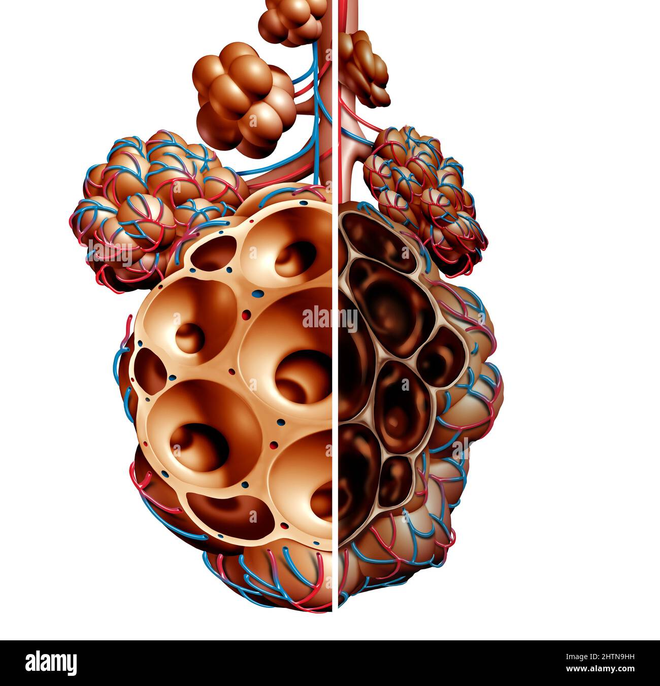 Emphysème comme essoufflement, trouble pulmonaire comme maladie de MPOC et maladie pulmonaire obstructive chronique concept comme bronchioles et alvéoles Banque D'Images Emphysème comme essoufflement, trouble pulmonaire comme maladie de MPOC et maladie pulmonaire obstructive chronique concept comme bronchioles et alvéoles Banque D'Images