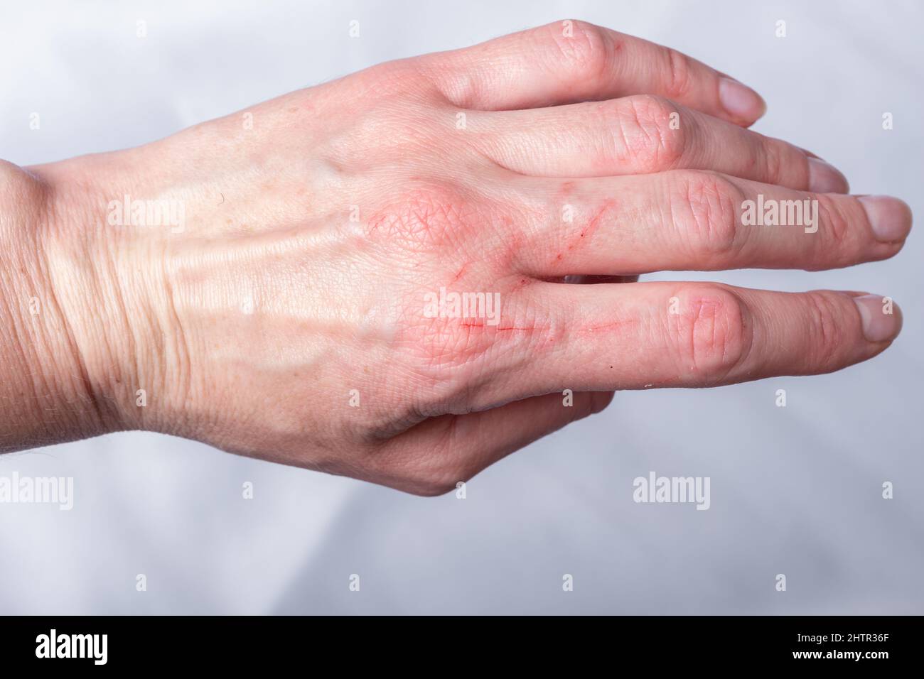 Maladie Des Griffes Du Chat Banque De Photographies Et D Images A Haute Resolution Alamy