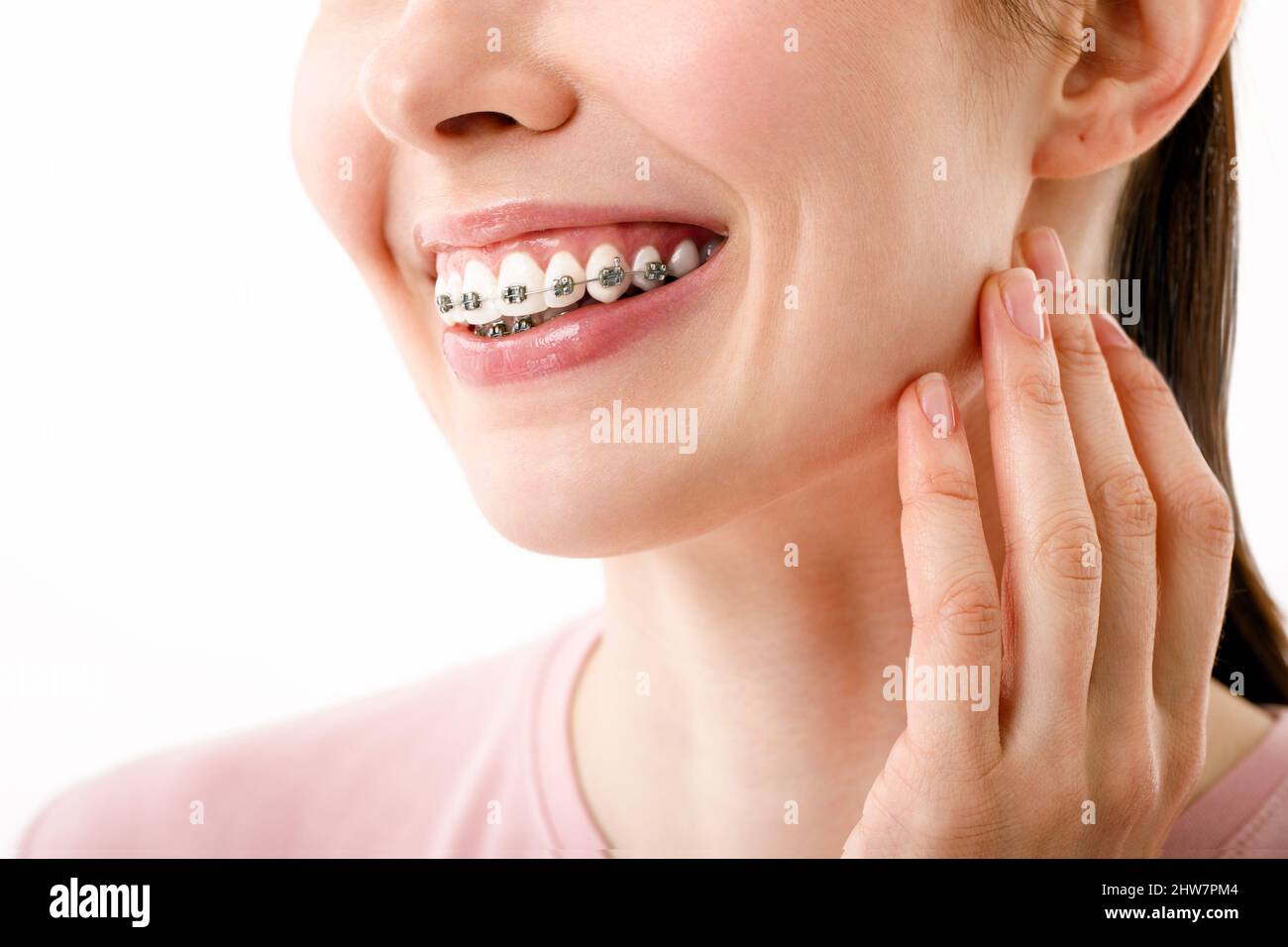 Sourire avec des bretelles traitement orthodontique. Concept de soins  dentaires. Belle femme en bonne santé sourire gros plan. Gros plan sur les  supports en céramique et en métal des dents Photo Stock -