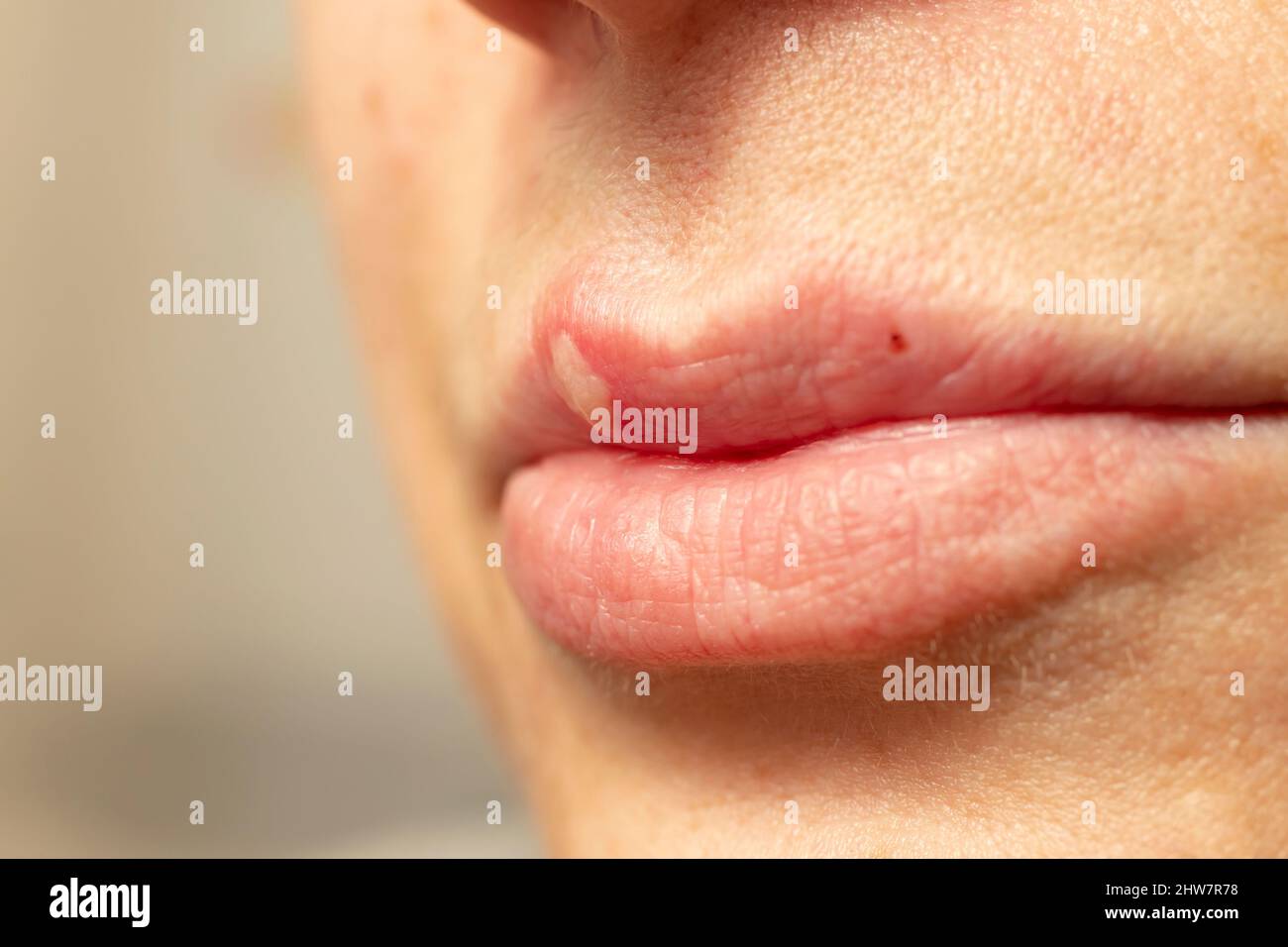 femme lèvres avec un virus herpès pustule, manifestation de l'herpès, faible profondeur de champ macro Banque D'Images femme lèvres avec un virus herpès pustule, manifestation de l'herpès, faible profondeur de champ macro Banque D'Images