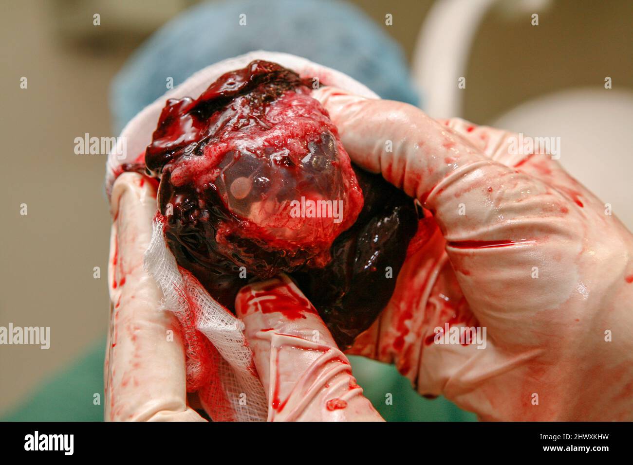Un chirurgien effectue une césarienne pour enlever un fœtus d'avortement  spontané (fausse couche) dans l'utérus de son patient. On ignore pourquoi  le mot Photo Stock - Alamy