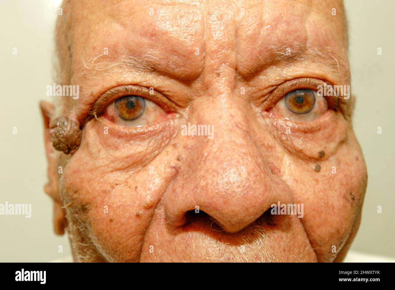 Un homme a un papillome de peau, une croissance bénigne de type mamelon à la surface de la peau ou de la muqueuse. (MODÈLE DISPONIBLE) Banque D'Images