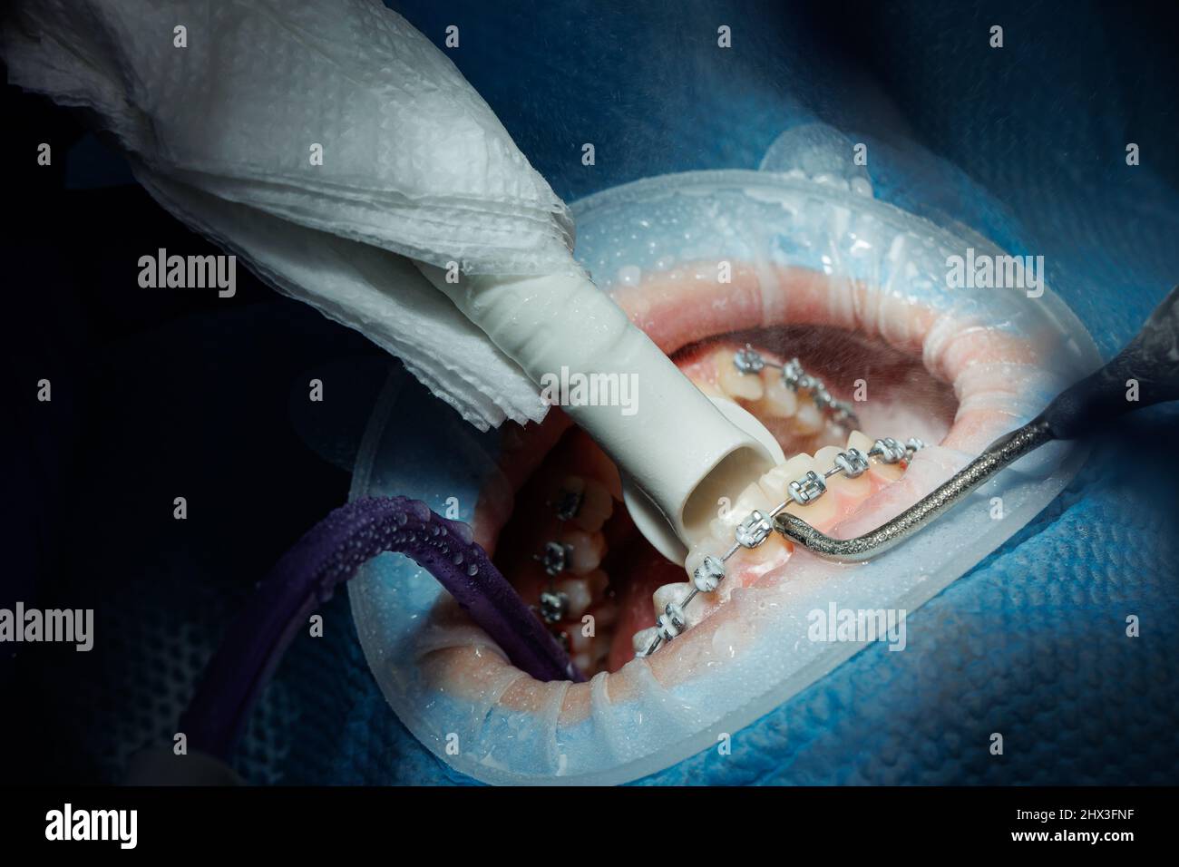 Vue de dessus du processus de brossage des dents du patient. Nettoyage des dents à l'aide d'un jet d'eau et d'un éjecteur de salive. Enrouleur de joue sur les lèvres. Le concept de pro Banque D'Images