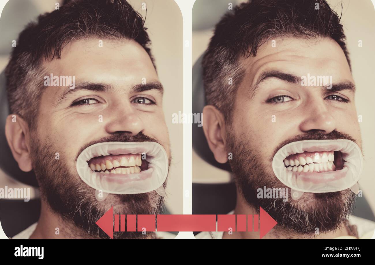 Dents jaune vs blanc, avant ou après le blanchiment. Homme avec un arrière-plan isolé touchant la bouche avec une expression douloureuse à cause de maux de dents ou dentaires Banque D'Images