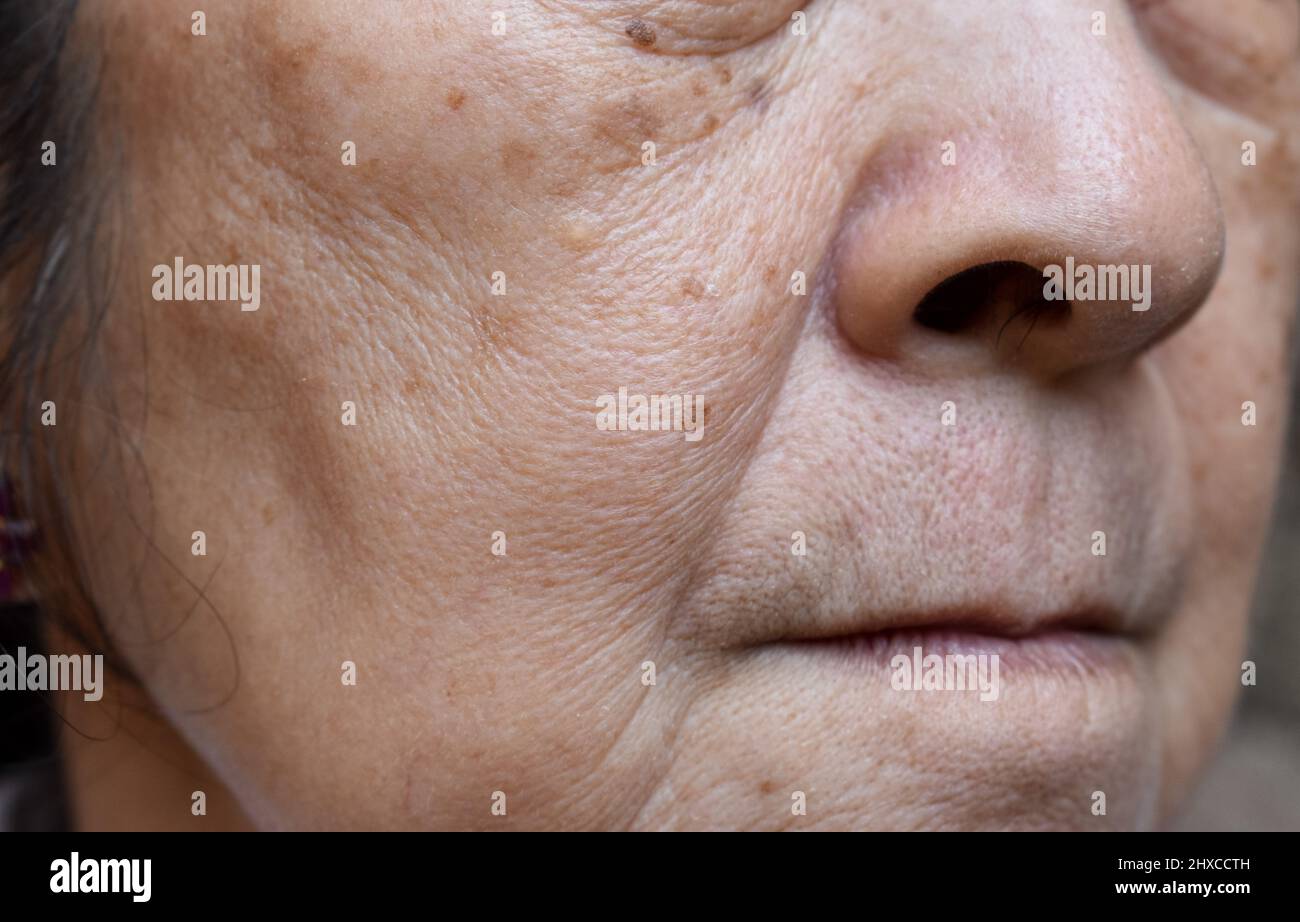 Pores agrandis face à l'asiatique du Sud-est, femme chinoise aînée avec plis de peau. Banque D'Images