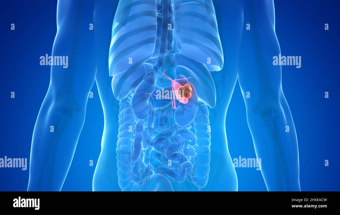 Cancer de la vésicule biliaire, illustration Photo Stock Alamy