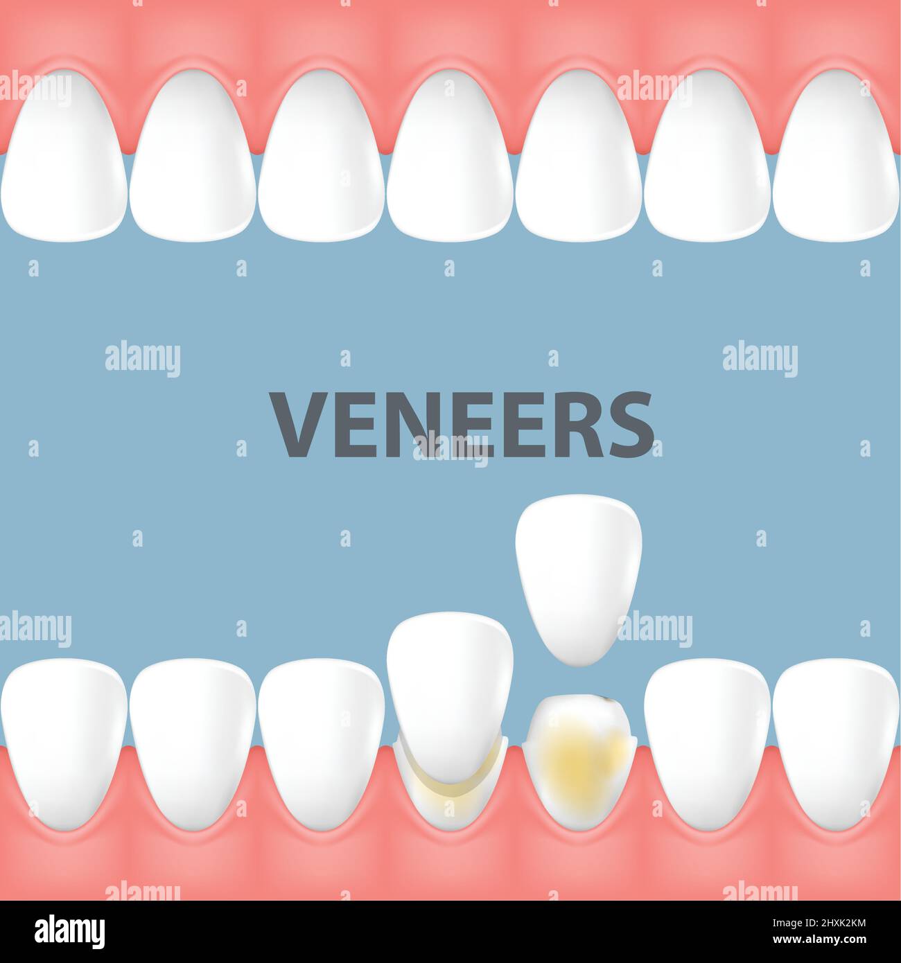 Dents et sourire relooking avec des facettes en céramique dentaire, rangée de dents avant et après couverture de placage, vecteur Illustration de Vecteur