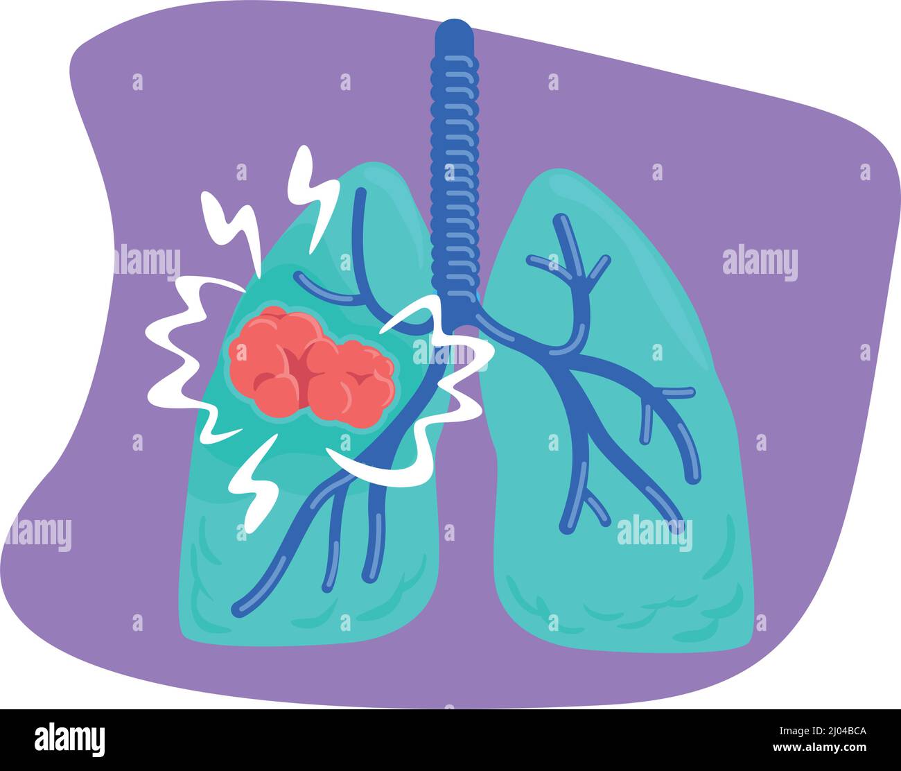 Illustration isolée du vecteur 2D du cancer du poumon Illustration de Vecteur