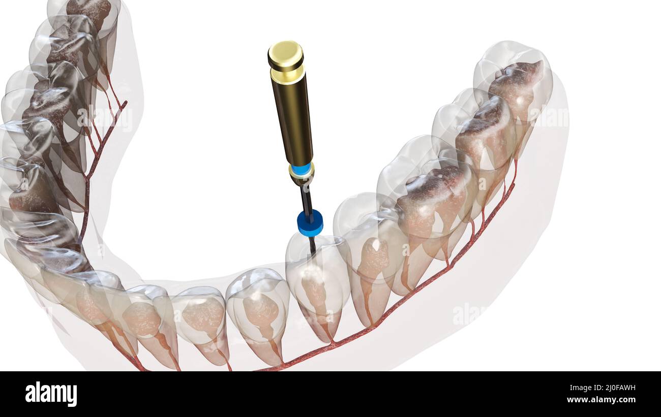 Traitement du canal racinaire, illustration Banque D'Images