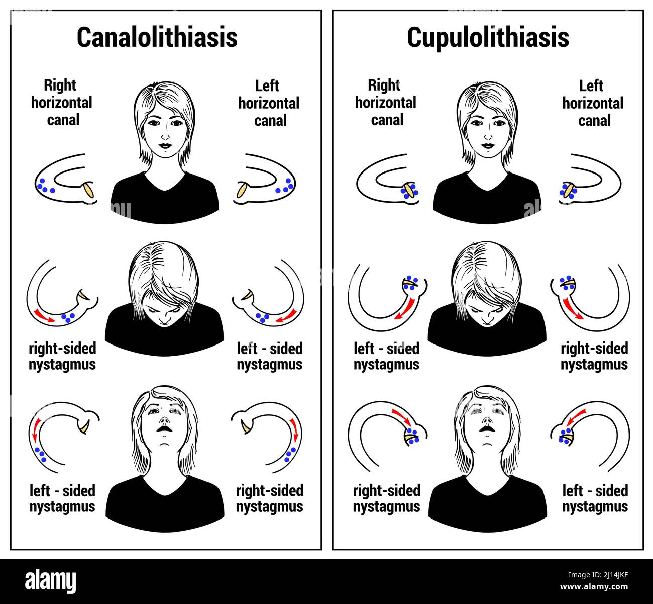 Vertige positionnel paroxystique bénin Banque de photographies et d