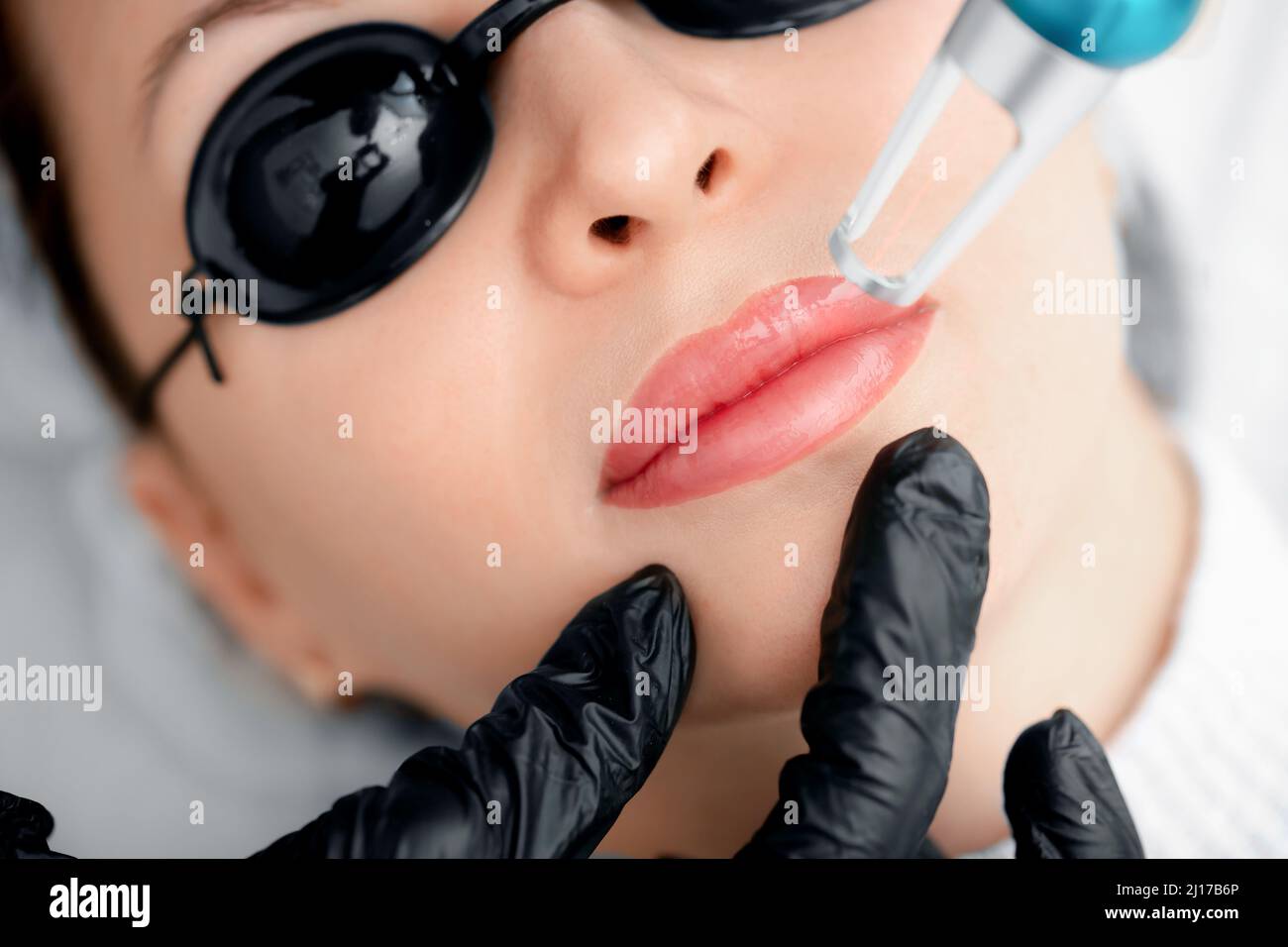 Retrait au laser du maquillage permanent sur les lèvres du visage de la jeune femme en salon. Banque D'Images