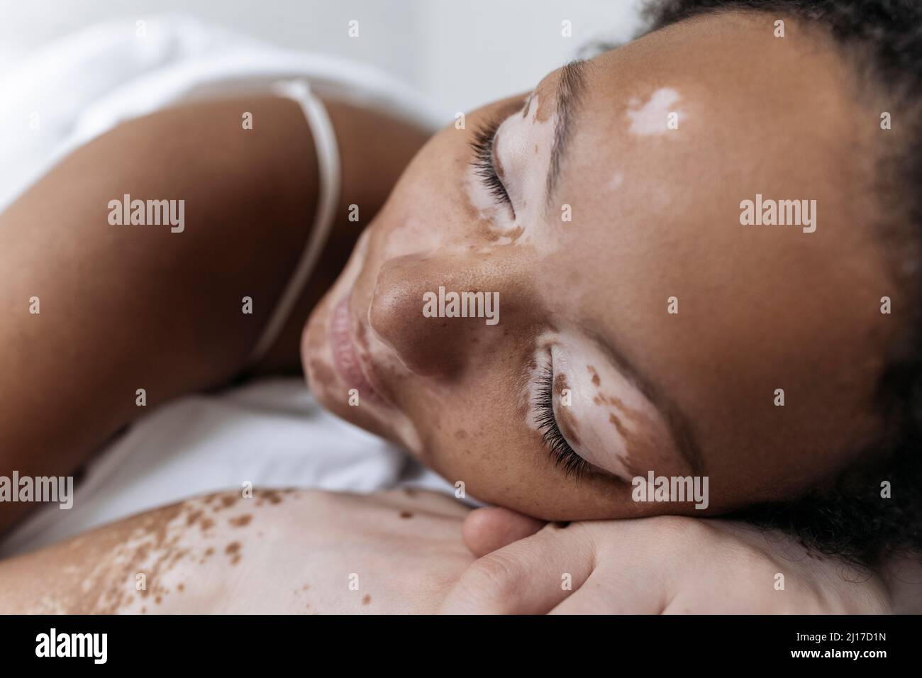 Femme avec vitiligo dormant à la maison Banque D'Images