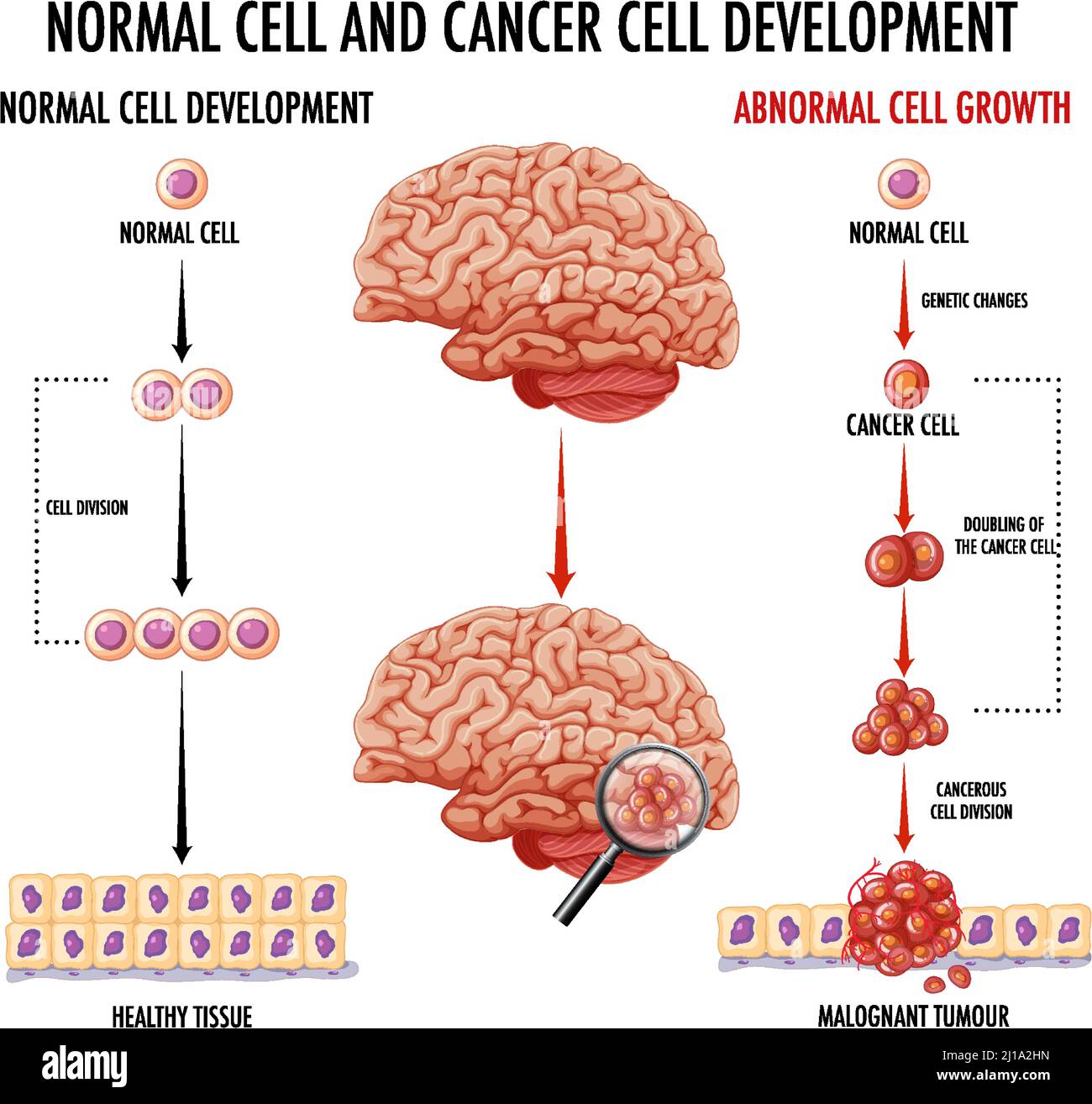 Schéma illustrant une cellule normale et une cellule cancéreuse Image ...