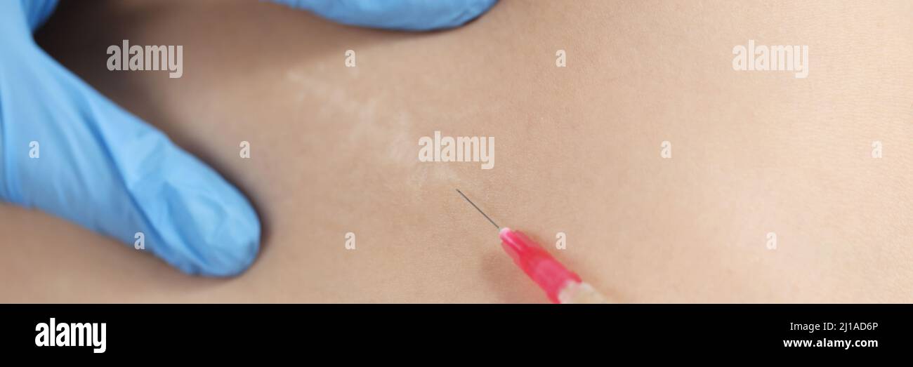 Médecin injectant des médicaments dans la zone de cicatrice postopératoire sur la peau de gros plan Banque D'Images