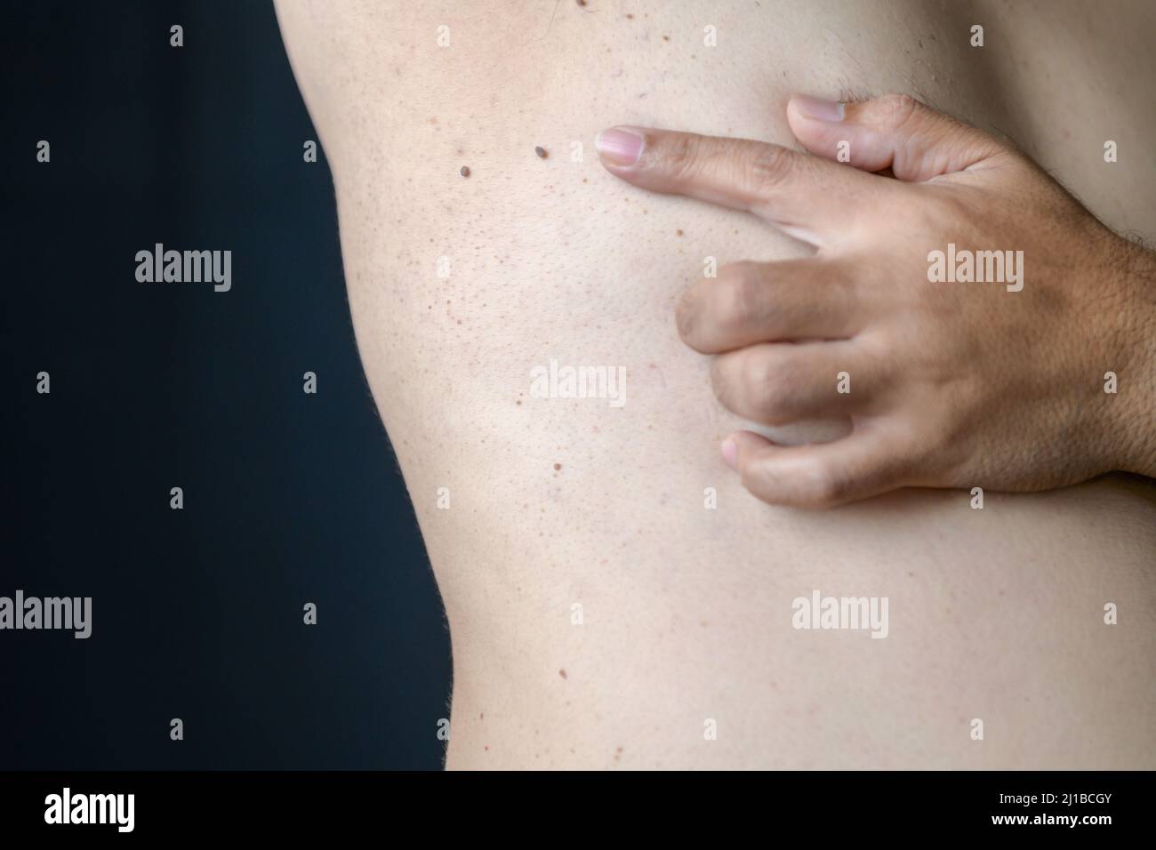 Fermé de la peau Tags ou Acrochordon sous l'aisselle sur fond noir. Concept de soins de santé Banque D'Images
