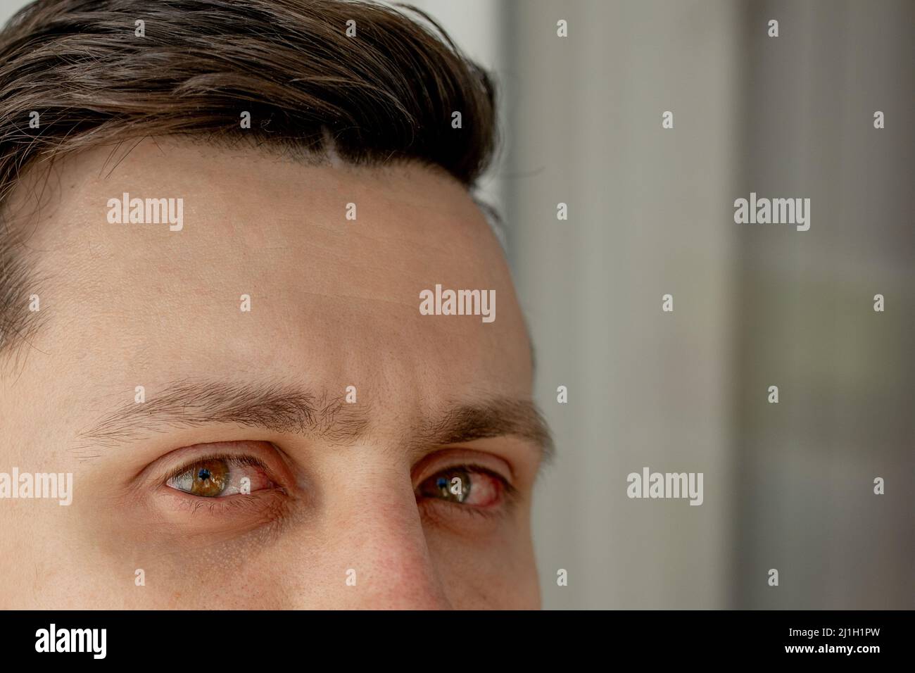 Un homme avec un oeil rouge et douloureux. Une infection au cours de la ...