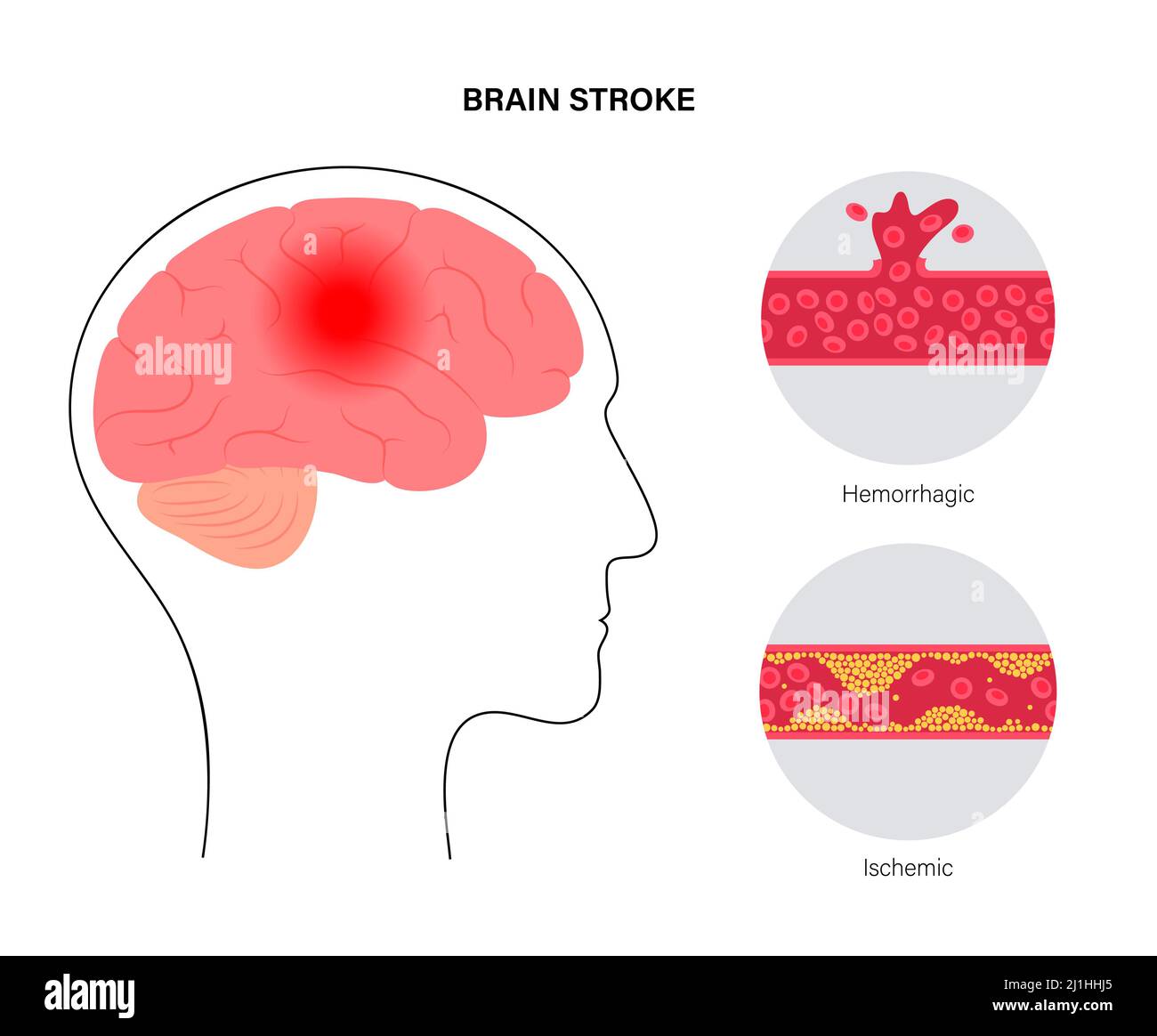 Accidents vasculaires cérébraux ischémiques et hémorragiques, illustration Banque D'Images