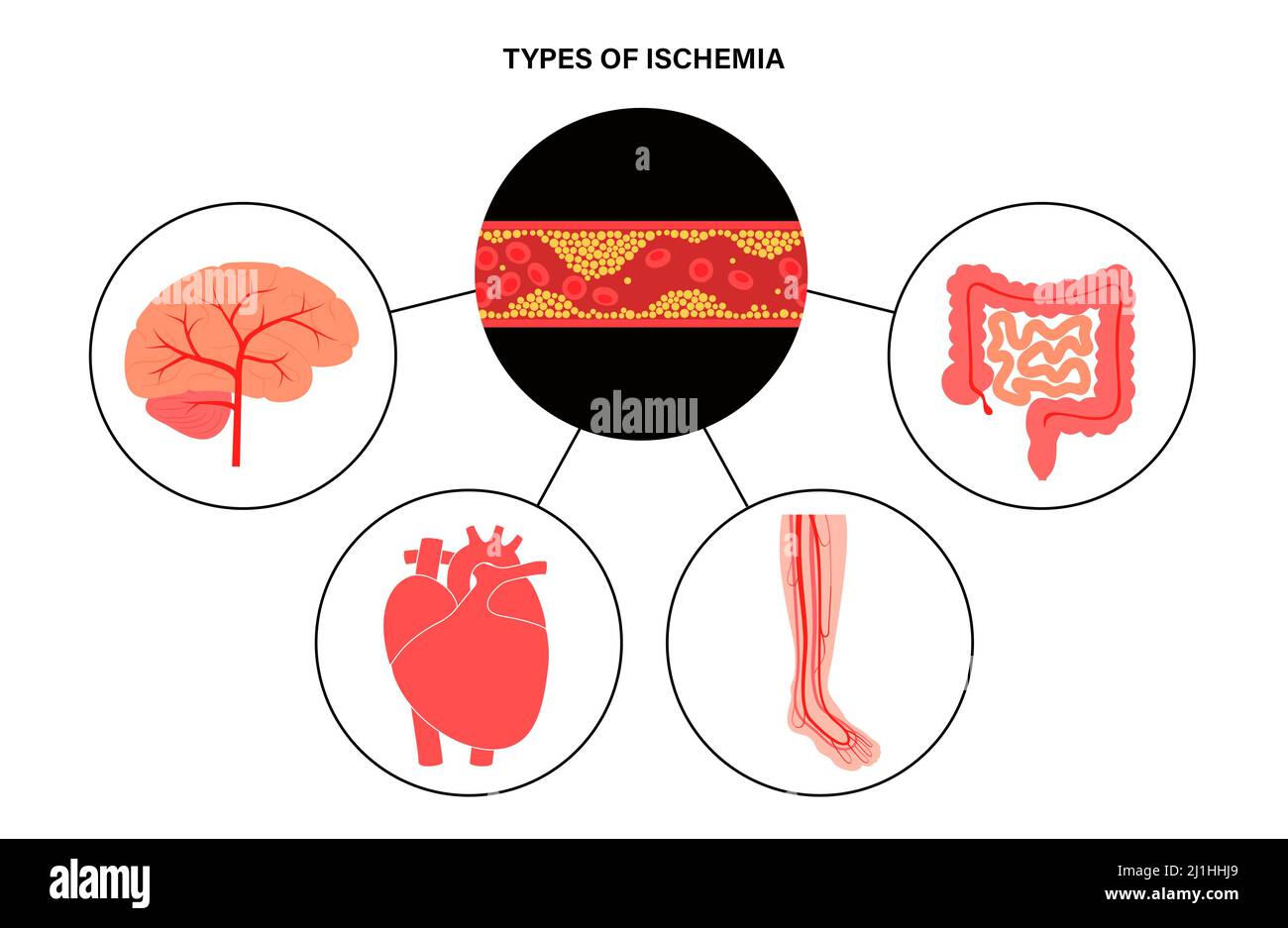 Types d'ischémie, illustration Banque D'Images