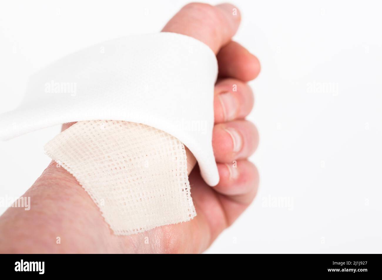 brûlure chimique sur la peau du poignet avec de l'hydroxyde de sodium acide. Festering et blessure profonde. Accident domestique, en raison de gants bleus à tranchant. Par. Stérile Banque D'Images