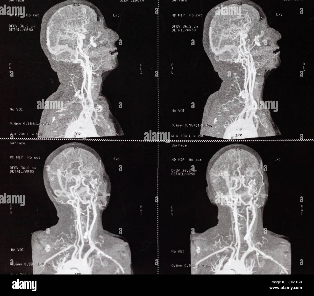 Photo en gros plan d'une IRM de contraste du crâne et des vaisseaux sanguins cérébraux d'une personne soupçonnée de sténose carotidienne Banque D'Images