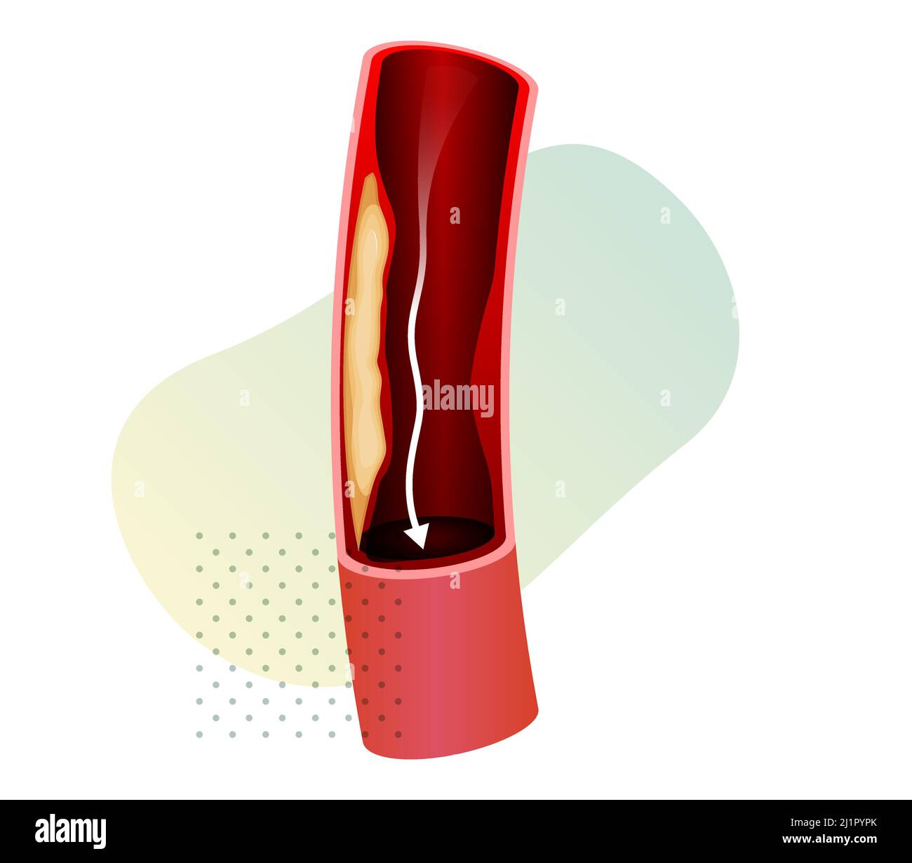 Débit sanguin restreint - Illustration du stock comme fichier EPS 10 Illustration de Vecteur