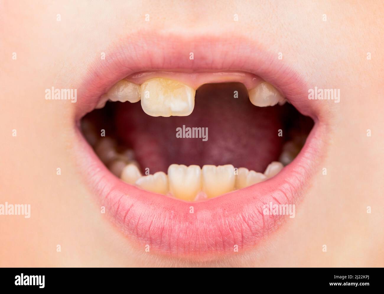 Mauvais dents enfant. Portrait garçon avec de mauvaises dents. L