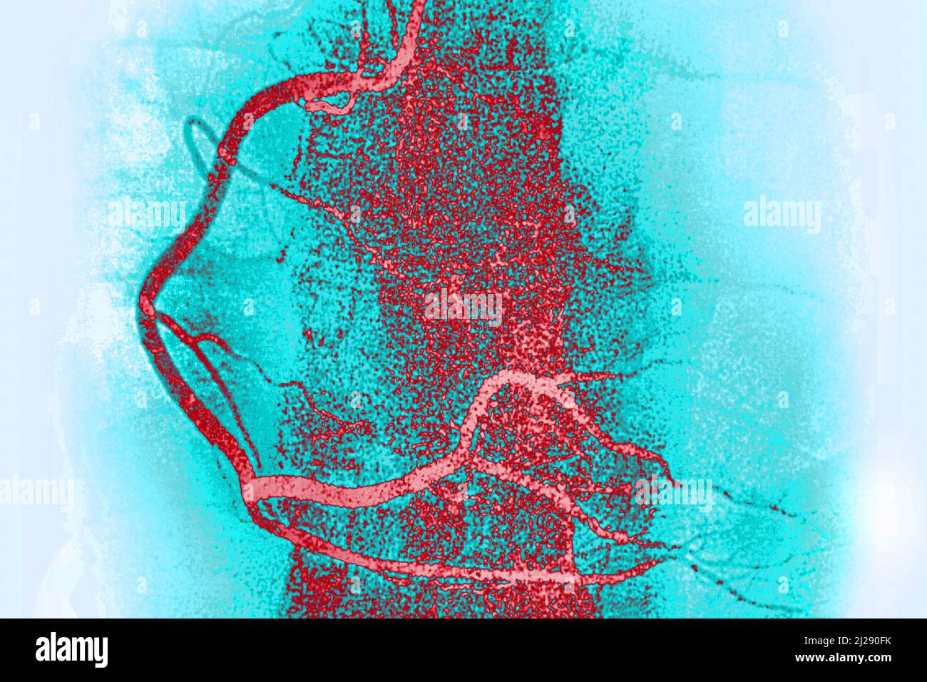 Artère coronaire droite Banque D'Images