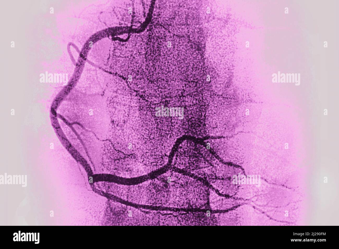 Artère coronaire droite Banque D'Images