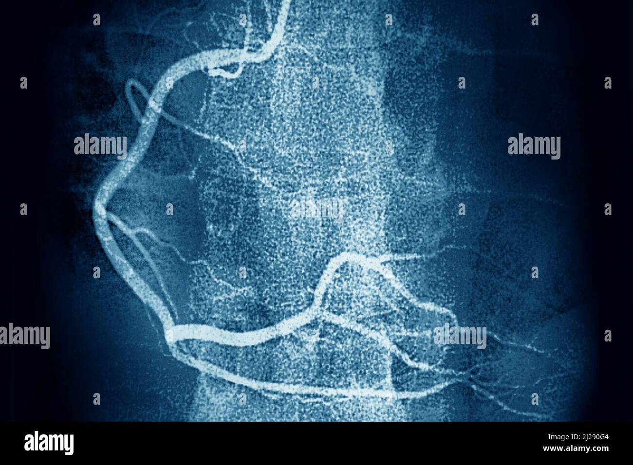 Artère coronaire droite Banque D'Images